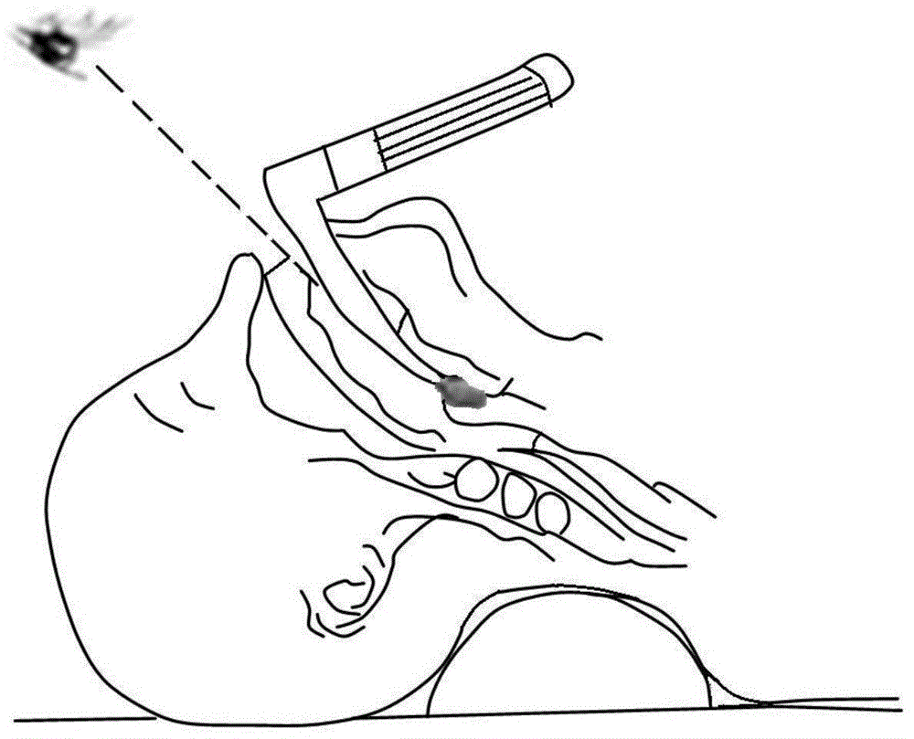 一种咽喉部内镜手术装置的制作方法