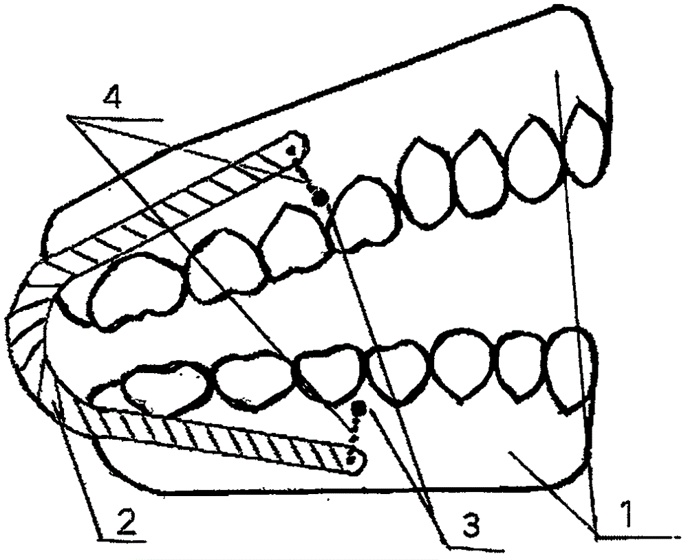 一种防止假牙脱落方法与流程
