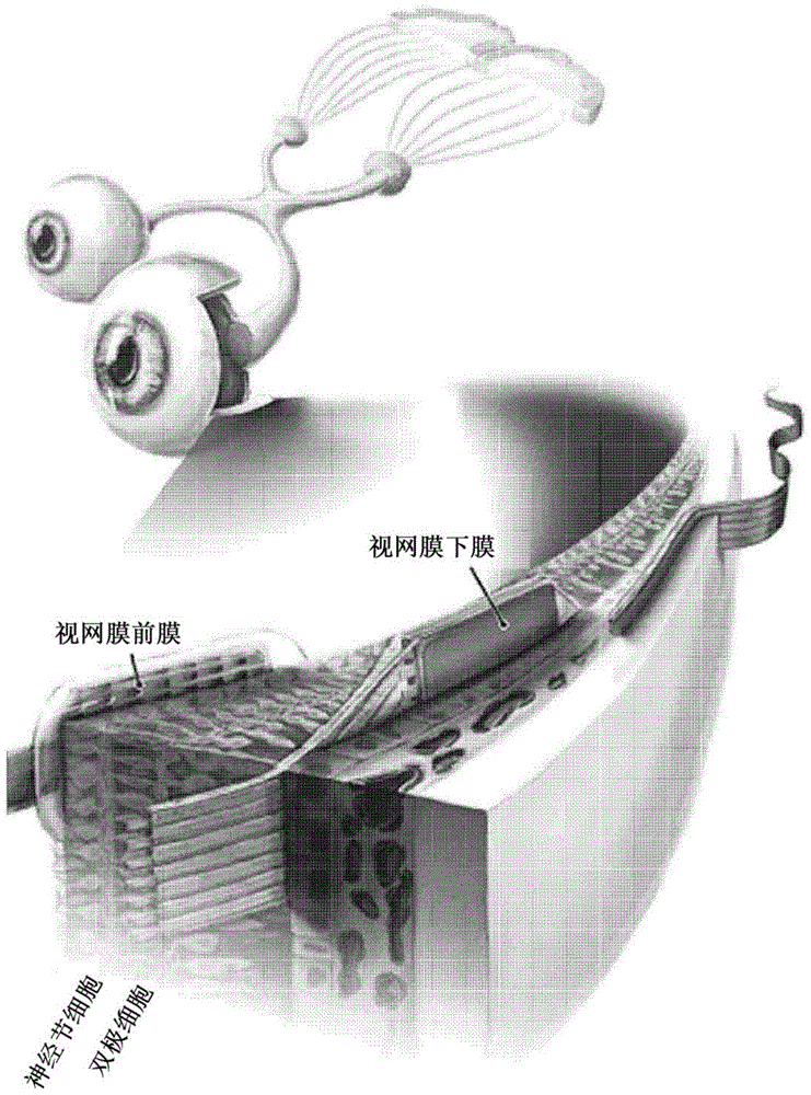用于提高对比敏感度的人造视网膜系统的制作方法