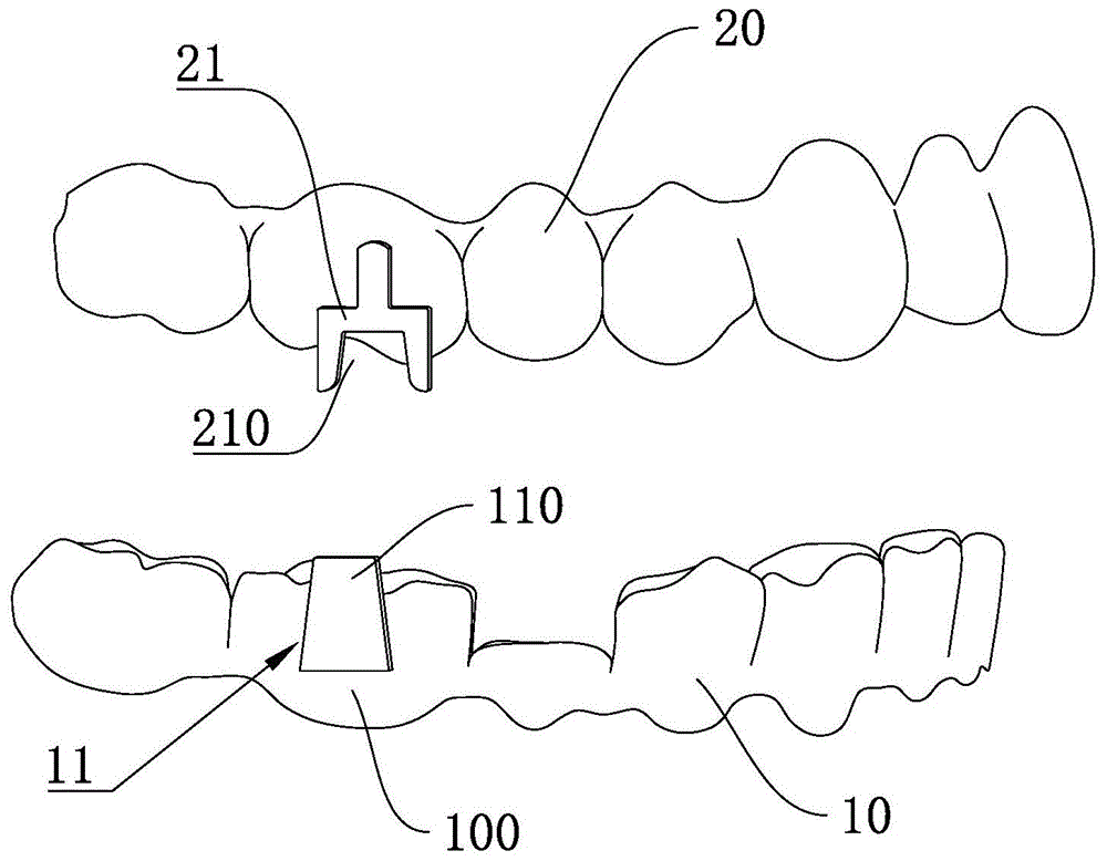 辅助磨牙前移的隐形牙齿矫正器的制作方法