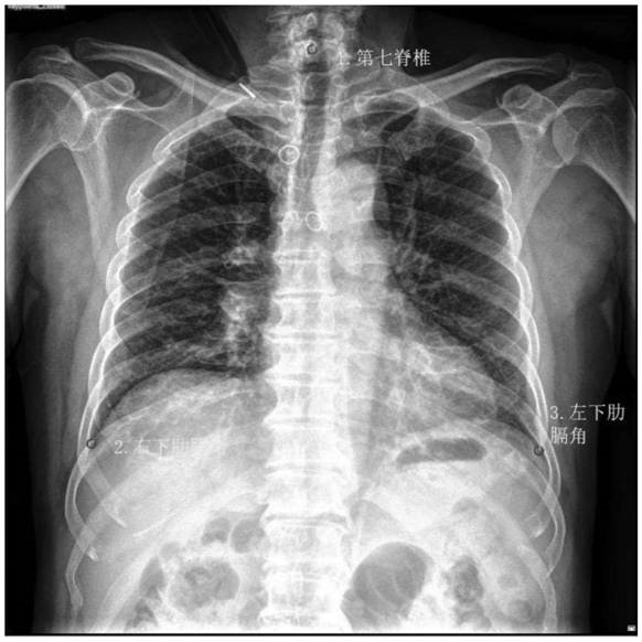 一种X光胸片中部位完整度的智能鉴别方法及系统与流程