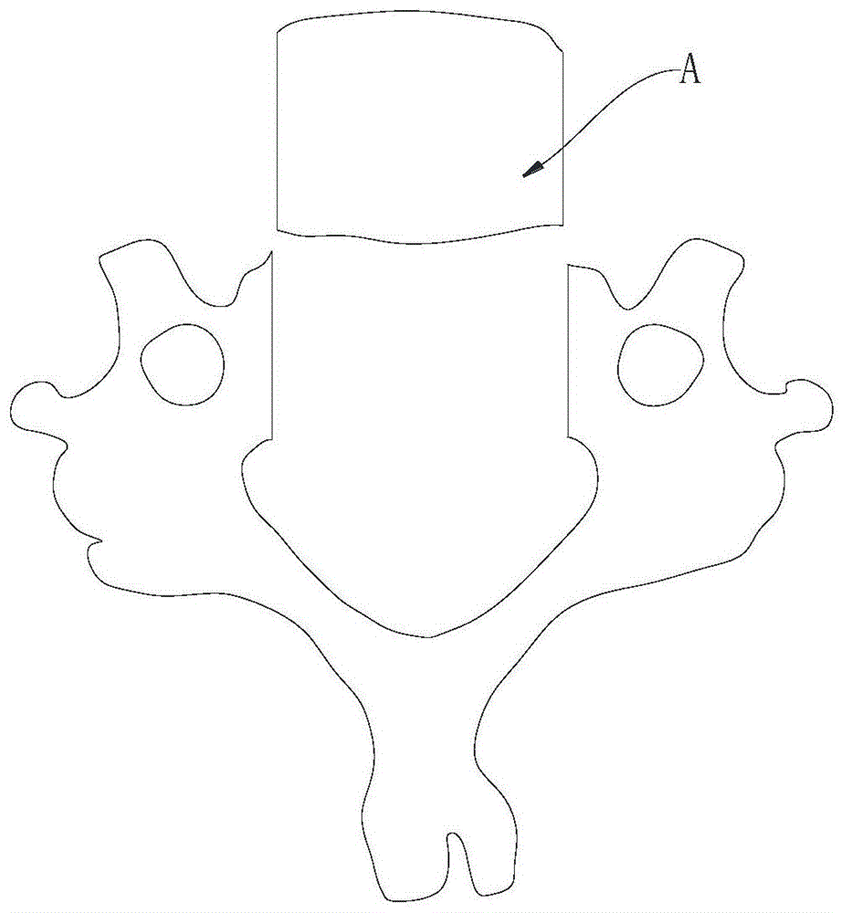椎体X形切除减压椎体成形椎间融合固定器的制作方法