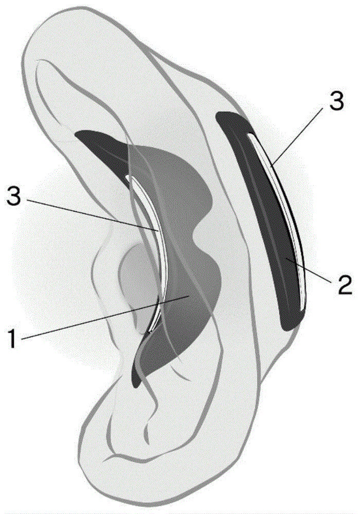 耳部轮廓维持装置的制作方法