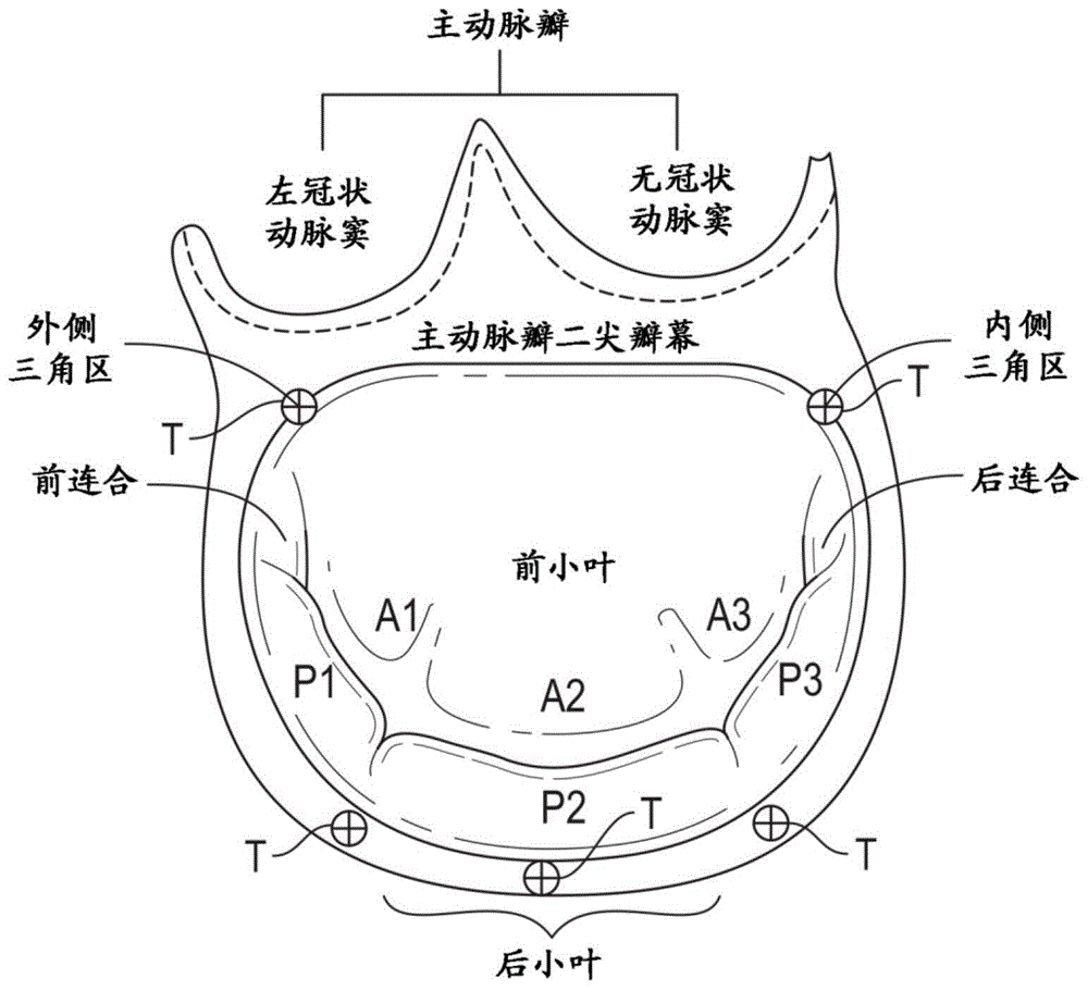 瓣环成形术系统的制作方法