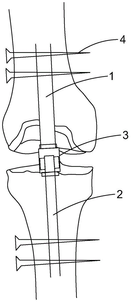 一种膝关节仿生髓内钉的制作方法