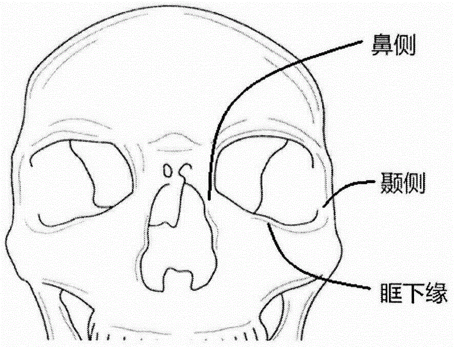 眶下区可植入复合假体及制作方法与流程