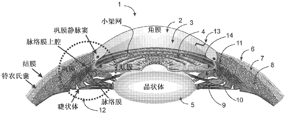 用于治疗青光眼的系统、方法和装置与流程