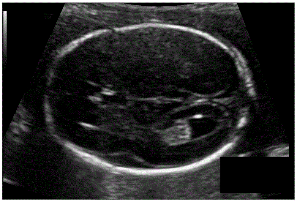 一种基于闭环最短路径的B超图像胎儿头围检测方法与流程