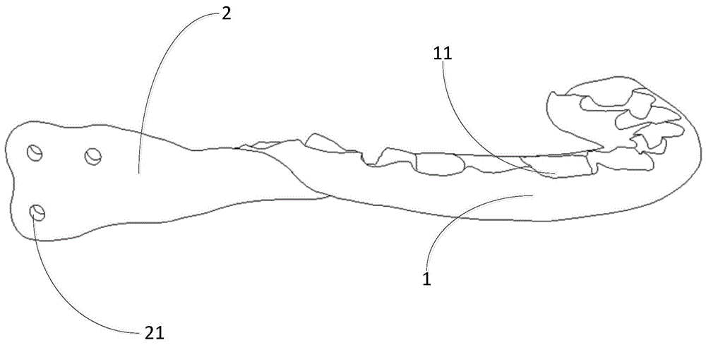 一种牙支持式下颌骨残端定位器的制作方法