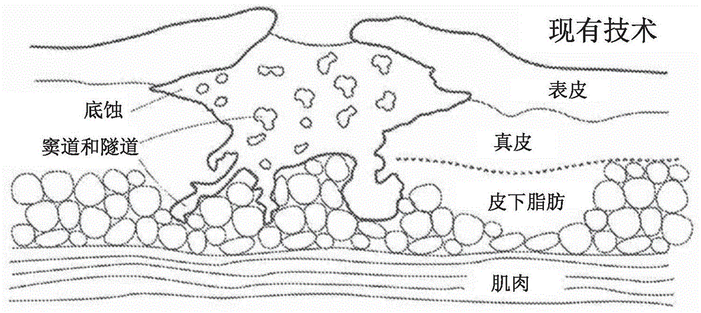 抗变形的伤口治疗装置及相关使用方法与流程