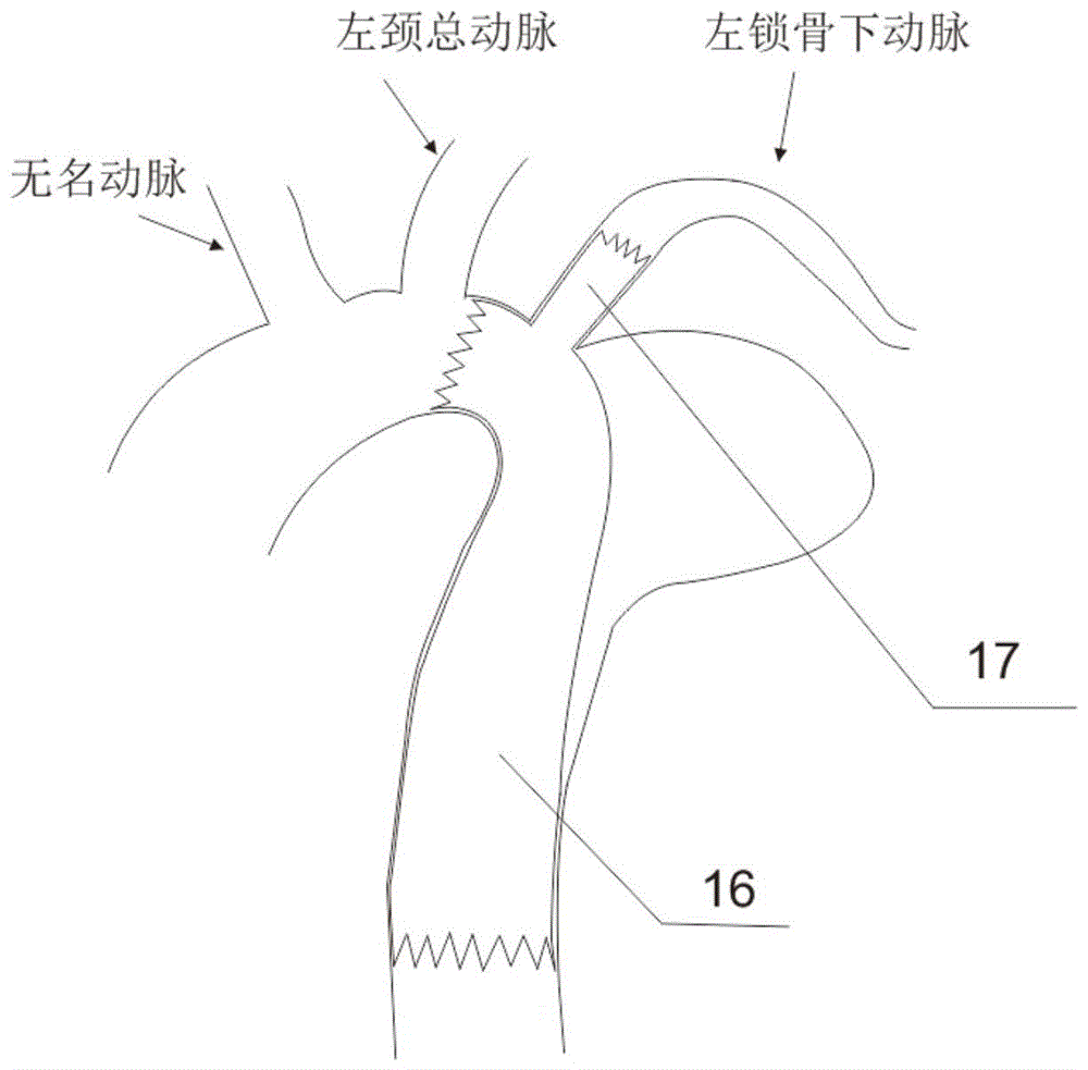 一种适用于胸主动脉瘤及胸主动脉夹层动脉瘤的覆膜支架的制作方法