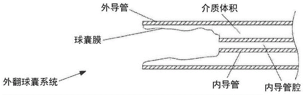 用于具有对准和顺应性加压的外翻导管的设备和方法与流程