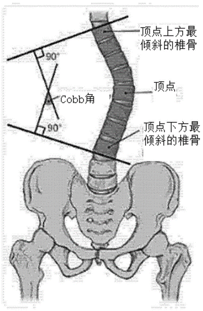 脊柱侧弯程度检测装置的制作方法