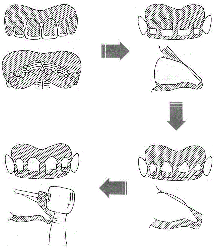 一种数字化设计制作的个性化牙体预备分步指示导板的制作方法