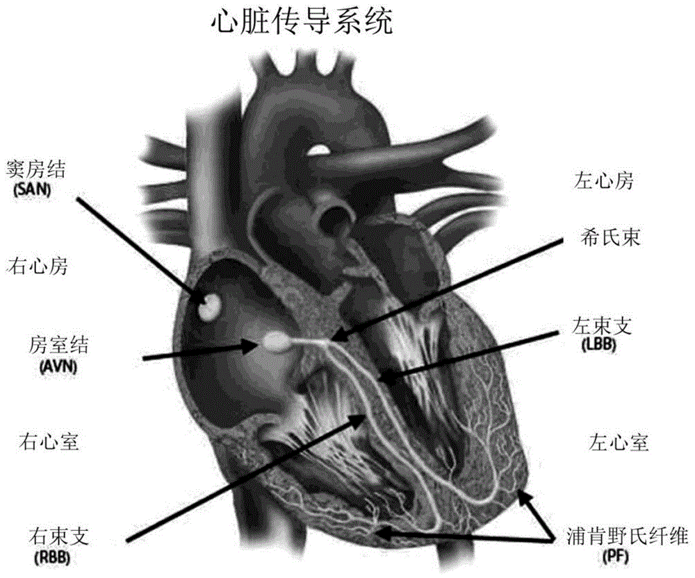 环扎心脏起搏器导线的制作方法