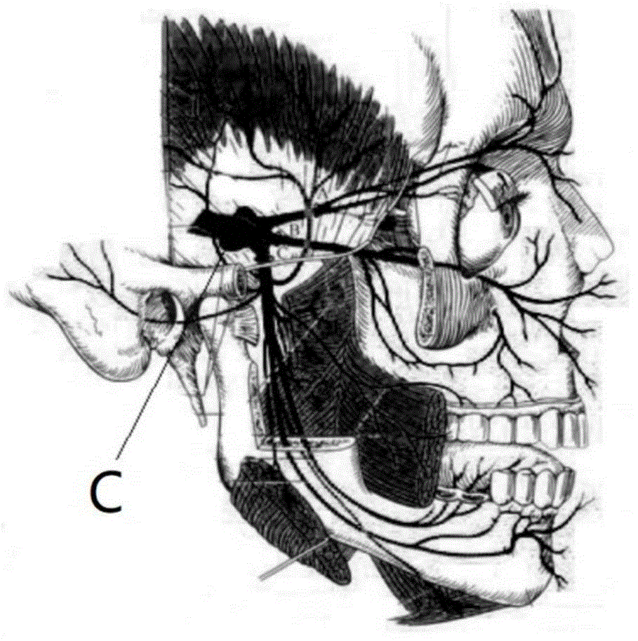 三叉神经半月节压迫球囊的制作方法