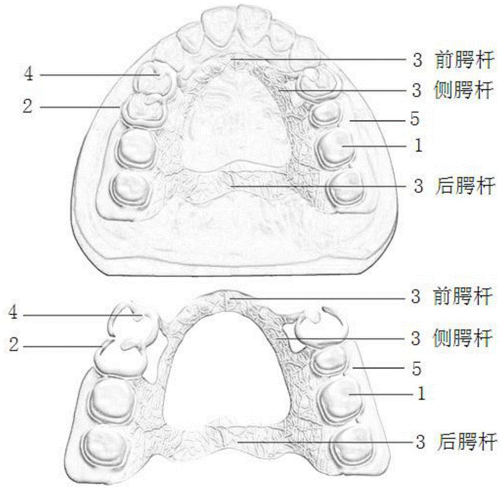 一种定制化聚醚醚酮可摘局部义齿支架的制作方法