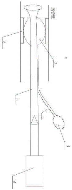 肠管内置型带球囊引流装置的制作方法