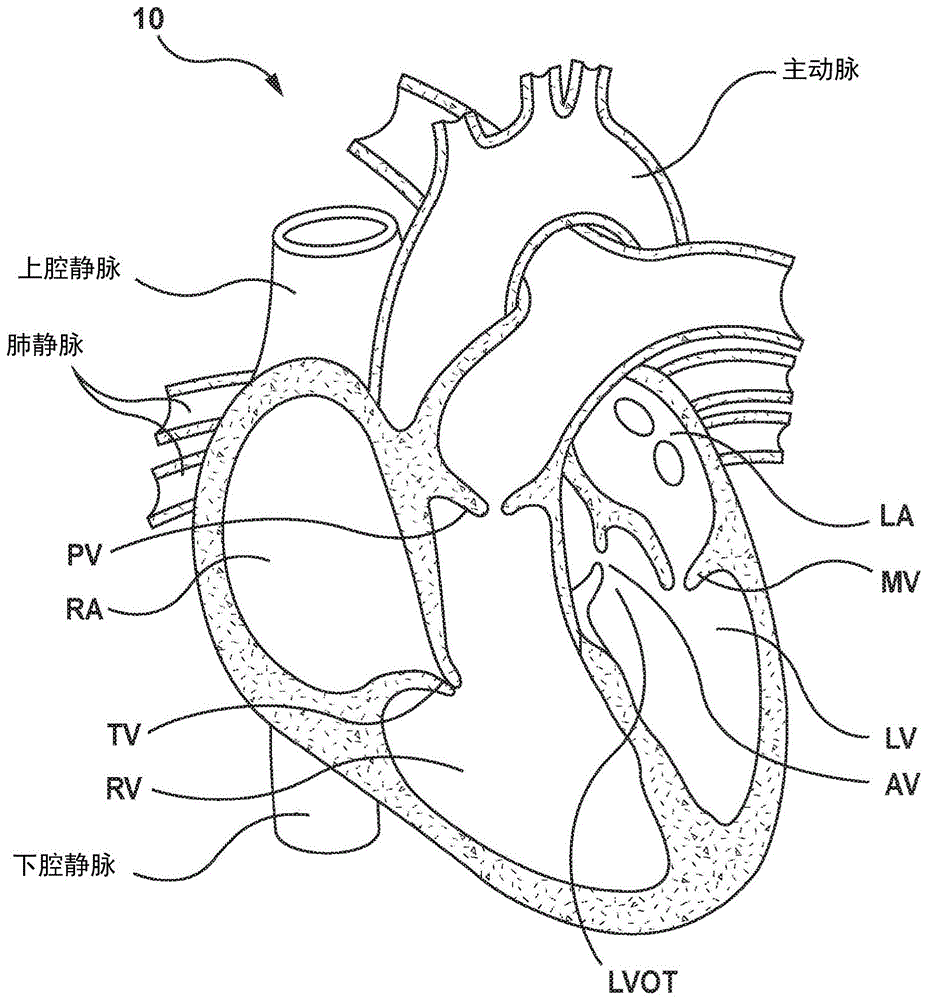可调节假体心脏瓣膜的制作方法
