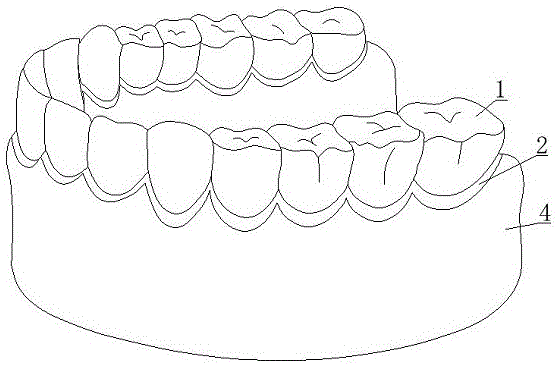背景技术:牙体,牙列的缺损和畸形所引起的口腔问题,影响人的咀嚼,发音