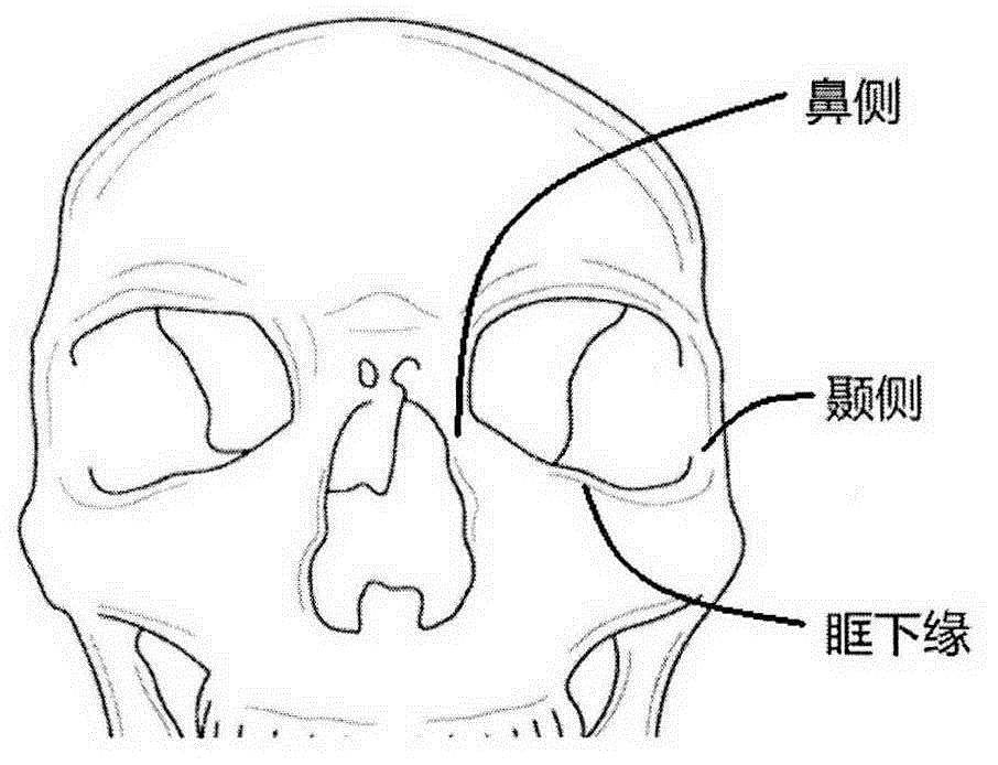 眶下区可植入复合假体的制作方法