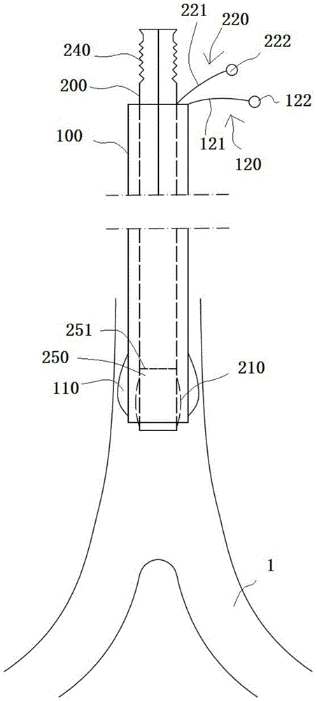 双套管支气管插管的制作方法