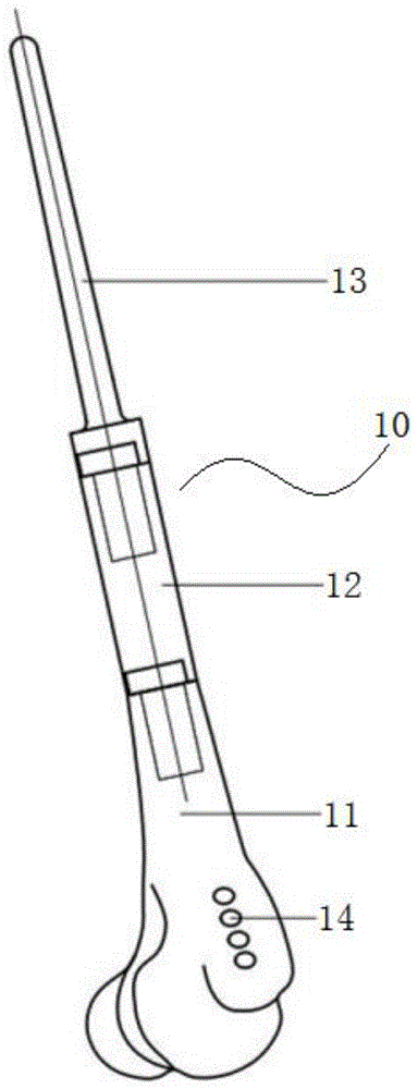 一种组配式肿瘤型人工肘关节假体的制作方法