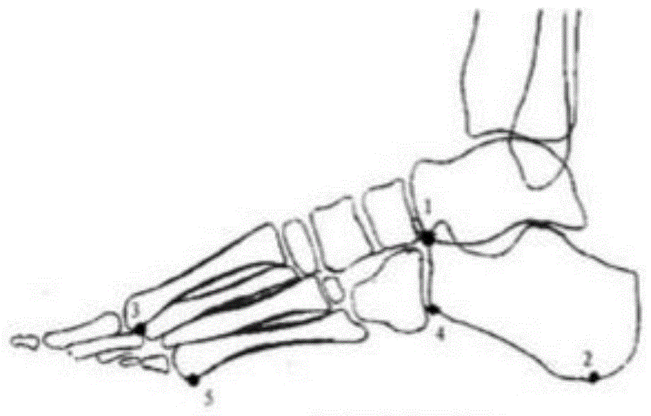 足弓破坏指踝关节或足损伤致跗骨骨折后足弓测量值背离临床医学足弓