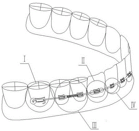 带树脂球的多功能口腔固定矫治器的制作方法
