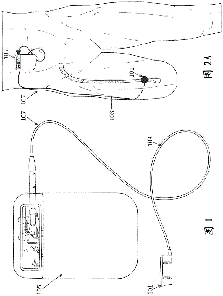 神经套囊部署装置的制作方法