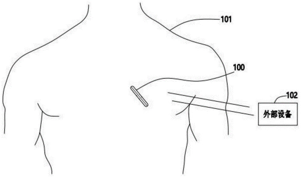 用于感知心电信号的植入医疗设备的制作方法