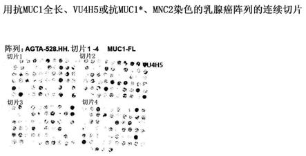 使用抗MUC1＊抗体的诊断方法与流程