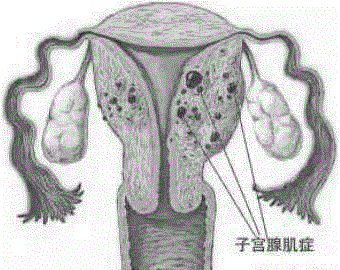 一种可精准定位消融子宫腺肌症的微波消融针的制作方法