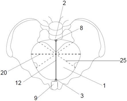 一种骨盆平面径线教学模型