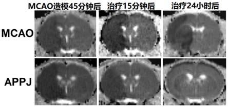 等离子在制备改善或治疗脑梗死和脑水肿的药物中的用途