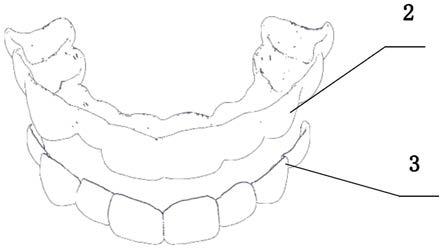一种无托槽矫正牙套及其制备和使用方法与流程