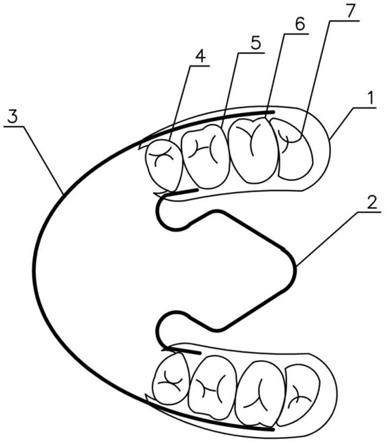 一种扩牙弓的活动矫正器的制作方法