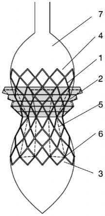 一种具有折叠式翼展裙边的球囊扩张式介入瓣膜支架的制作方法