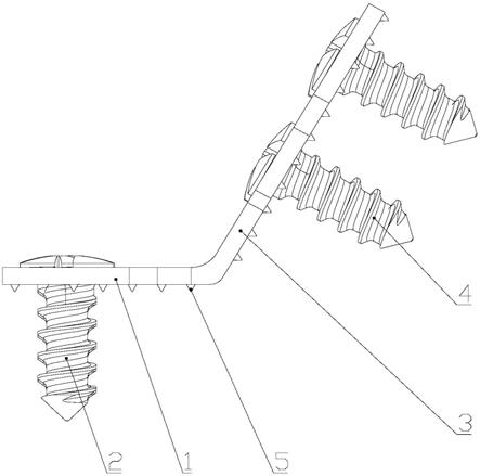 一种新型有限接触式椎板固定板钉系统的制作方法