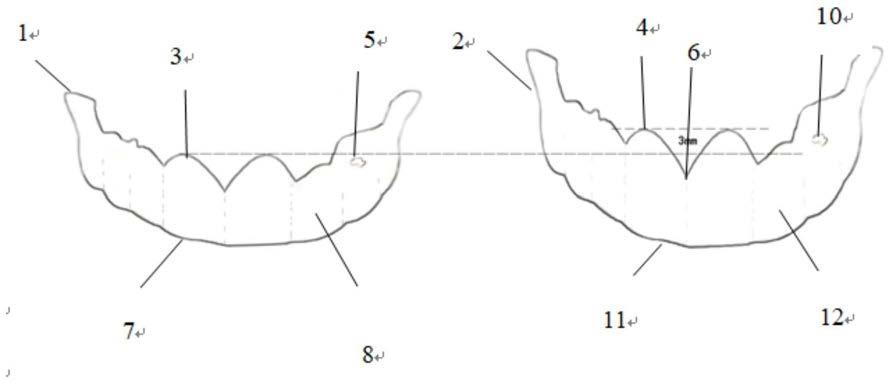 指导牙冠延长手术的3D打印双导板套件的制作方法
