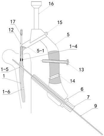 一种股骨转子间骨折适形钉内固定系统的制作方法
