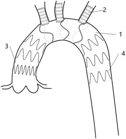 一种主动脉弓原位开窗专用覆膜支架