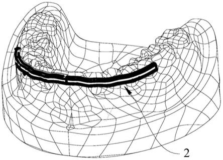 可实现三维控制的隐形矫治器的制作方法