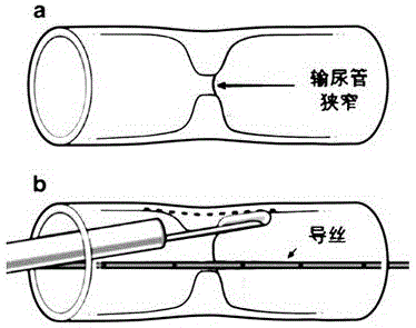 一种应用于泌尿道修复术中的多维内切刀的制作方法