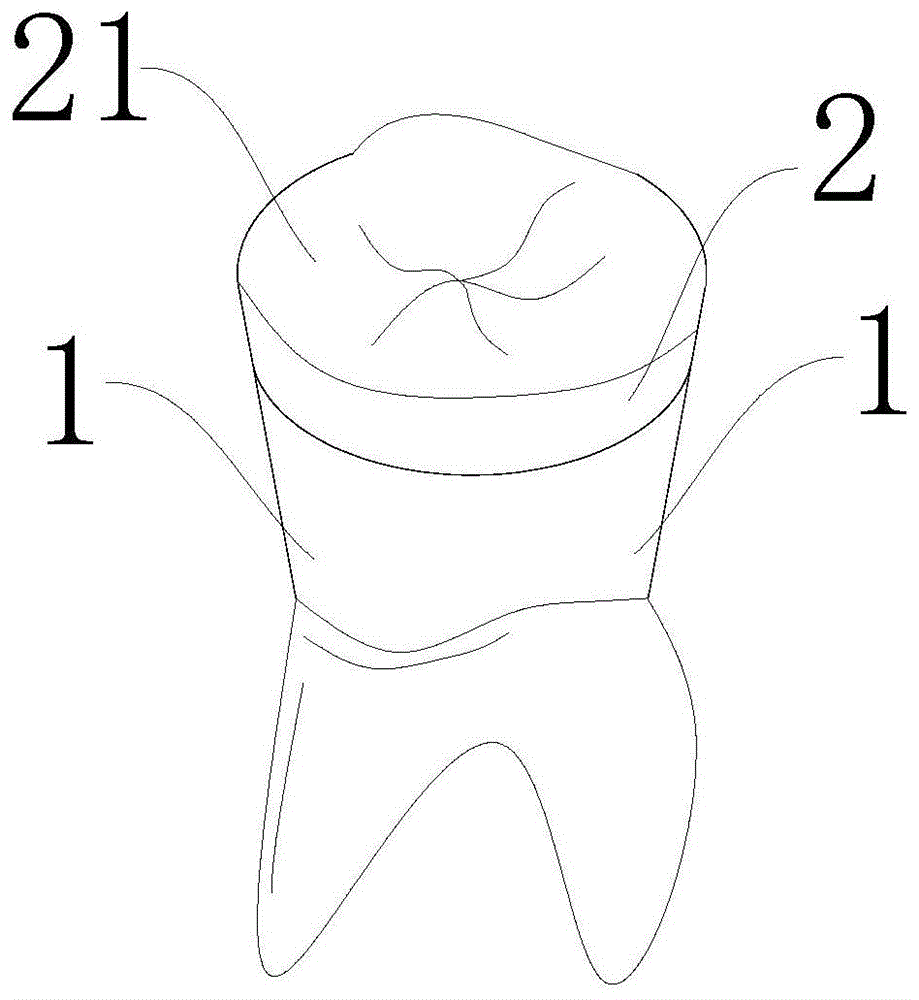 一种榫接式可替换牙冠的制作方法