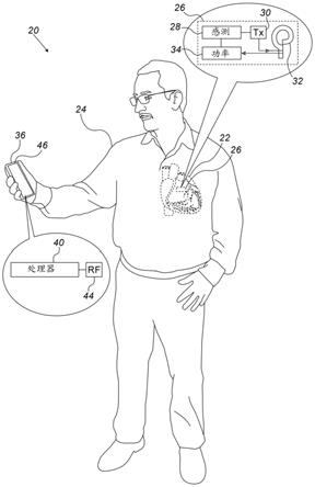 使用由植入物记录的心电图（ECG）信号的调幅（AM）来监测呼吸的制作方法