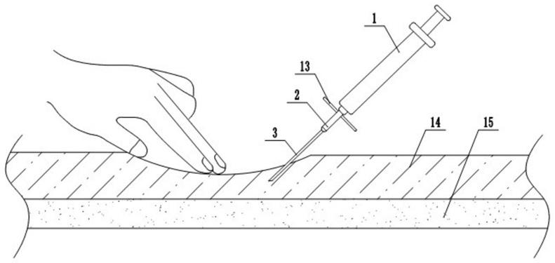 一种肥胖病人的动脉穿刺针