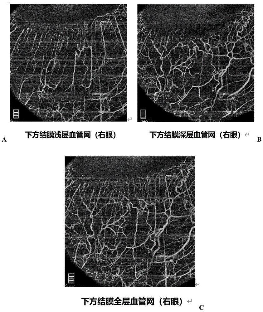 一种光学相干断层血管成像的眼前节成像方法