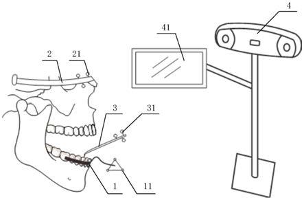 下颌运动捕捉系统、捕捉方法以及模拟方法与流程