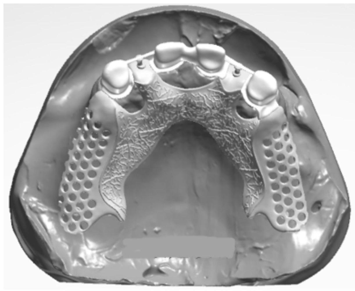 基于3D打印的套筒冠及其制作方法与流程